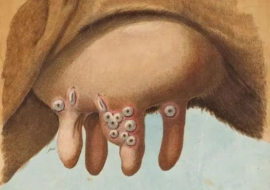 &nbsp;牛痘&nbsp;|&nbsp;图源 hagstromerlibrary.ki.se