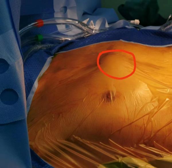 30岁出头的健身小伙胸口鼓大包瑞金专家为其拆弹重获新生