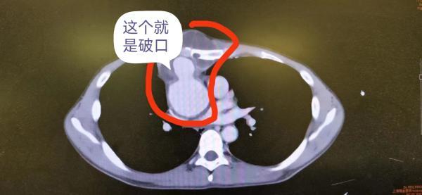 的一些因自身免疫性疾病导致的心脏瓣膜或大血管病变的病例表现很相似