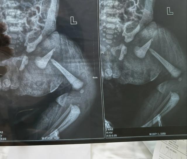 河南一新生儿左腿股骨干骨折医院在走纠纷调解程序尚不能确认为医疗