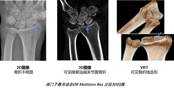 悬吊DR怎么安装价超64排CT 悬吊式CBCT-DR凭创新实力出界_https://www.jmylbn.com_新闻资讯_第5张
