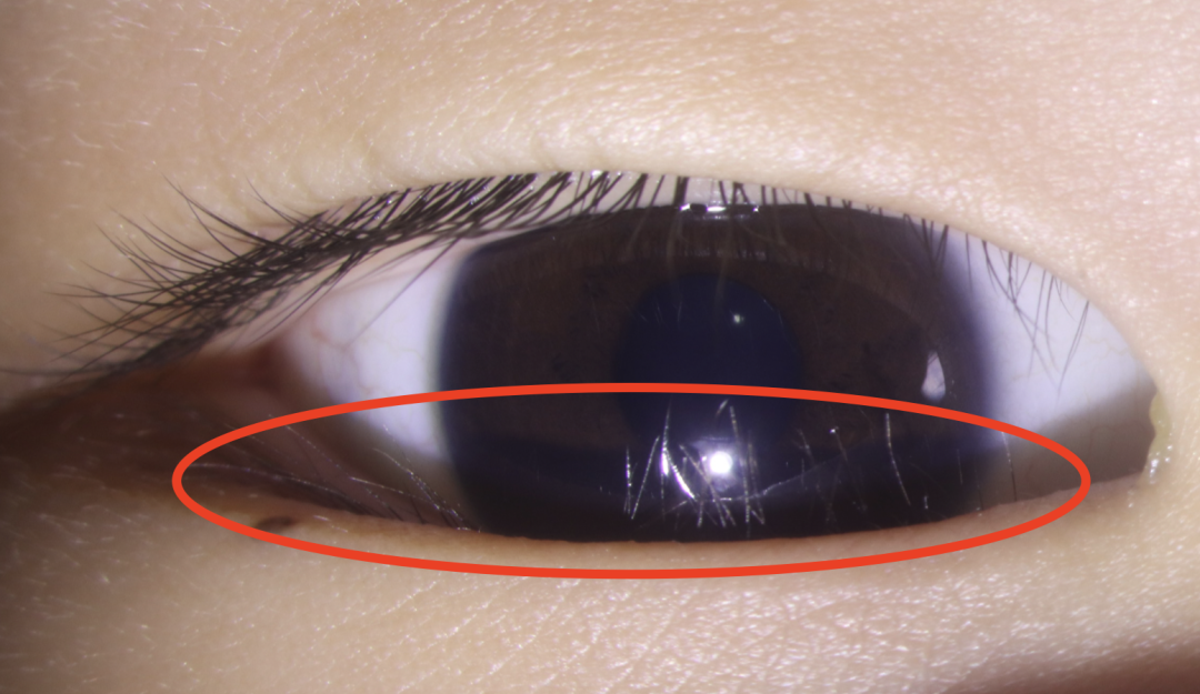 倒睫资料图,图源:深圳市眼科医院 眼整形与泪器病科