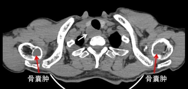 图4.胸部CT:右侧甲状腺背后甲状旁腺腺瘤(白箭头)，双侧肱骨骨囊肿(红箭头)