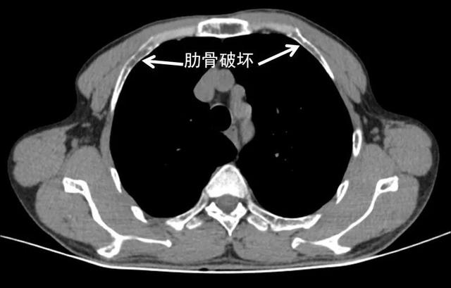 胸部ct见多处肋骨破坏