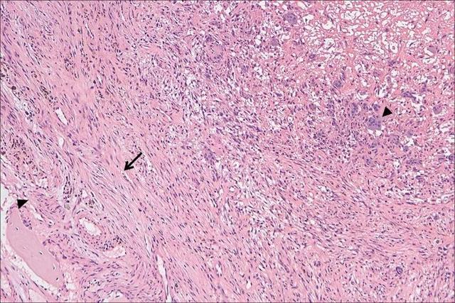 组织病理:少量骨组织(左下三角),大量纤维组织(中间