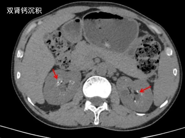 双肾实质泥沙样钙质沉着