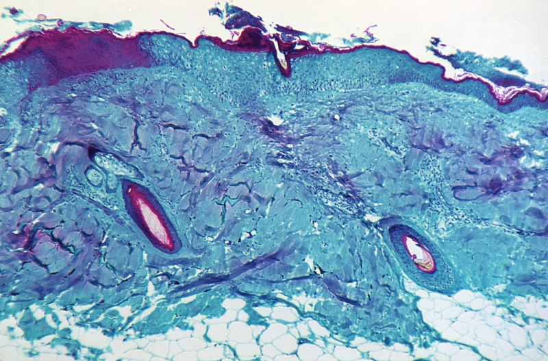 下,显示了从一只感染了猴痘病毒的猴子皮肤病变处获取的皮肤组织切片