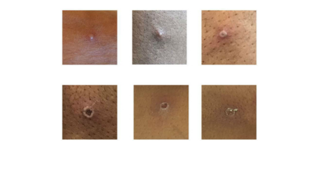 图为猴痘患者皮肤表面出现的症状 图片来源：英国卫生安全局