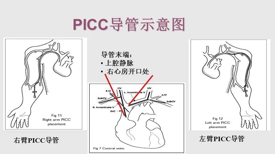 方塔中医医院picc专科护理门诊即将开诊