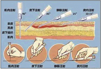 打残二舅的屁股针为何基本消失了