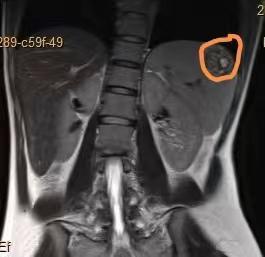 安徽一医院发现1例!全球仅报告20例|宫外孕_新浪财经_新浪网