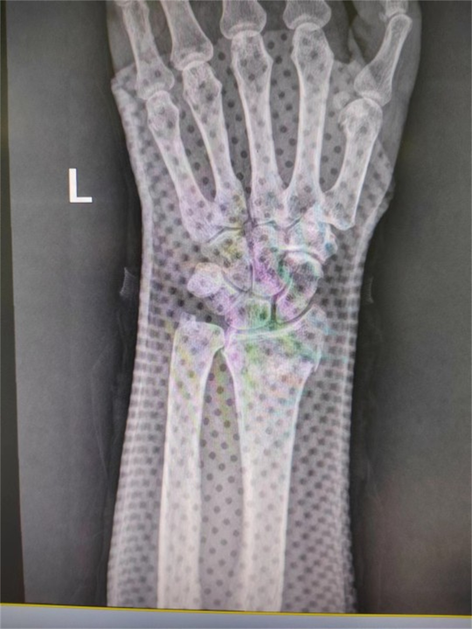 黑格科技骨科康复产品腕关节固定器应用于桡骨远端骨折 骨裂治疗案例分享 骨折 石膏 骨科 新浪新闻