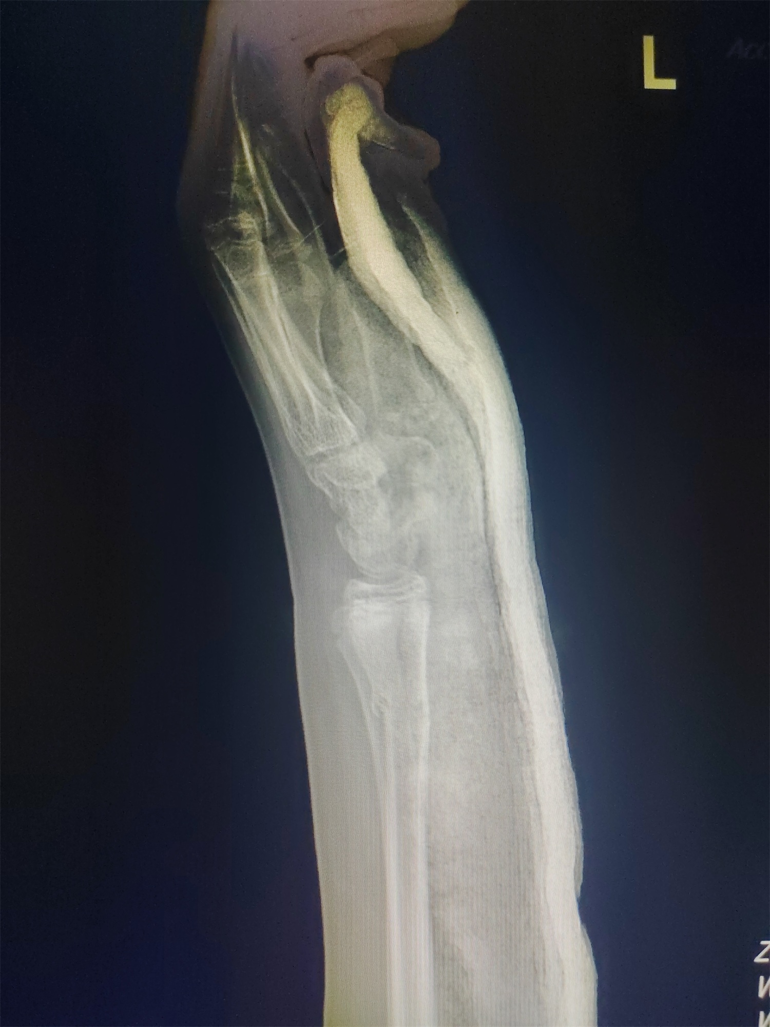 关节康复器怎么用黑格科技骨科康复产品腕关节固定器应用于桡骨远端骨折、骨裂治疗案例分享_https://www.jmylbn.com_新闻资讯_第1张