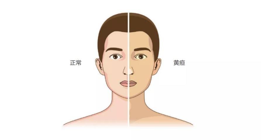 不只皮肤有点黄,还有可能是肝损伤!|黄疸|胆红素|护肝_新浪新闻