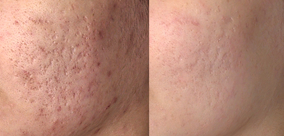 针对痘坑痘印2次治疗前后对比图