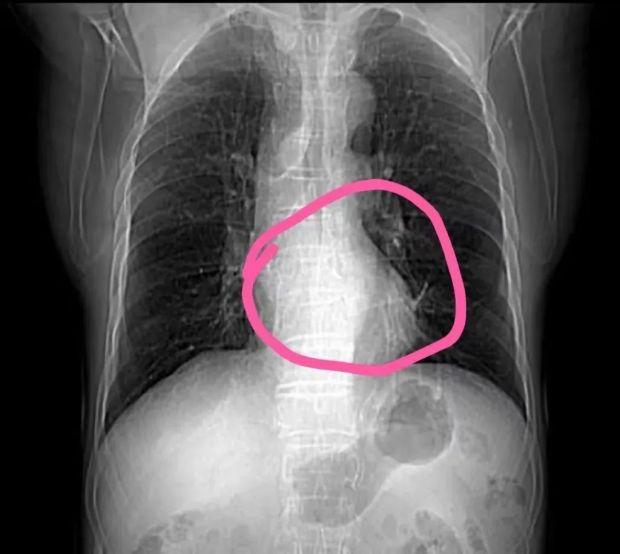 正常人的心脏在左胸/图源:浙大一院