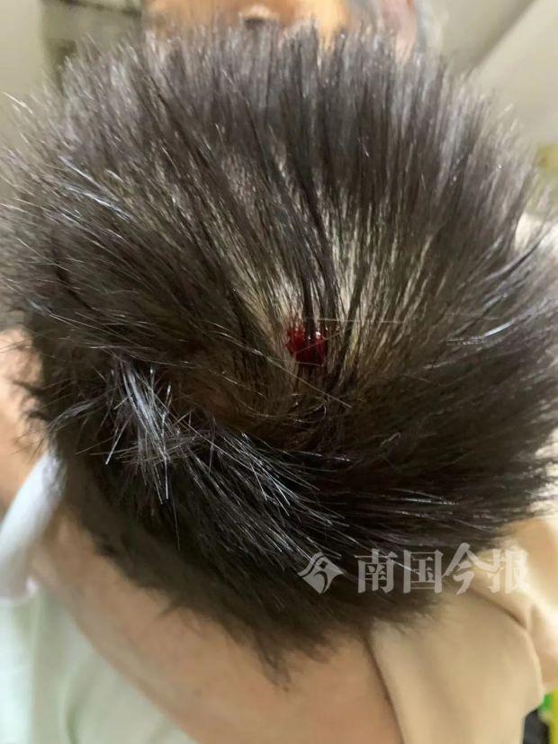 杜先生小孩的头部被砸破出血.受访者供图.