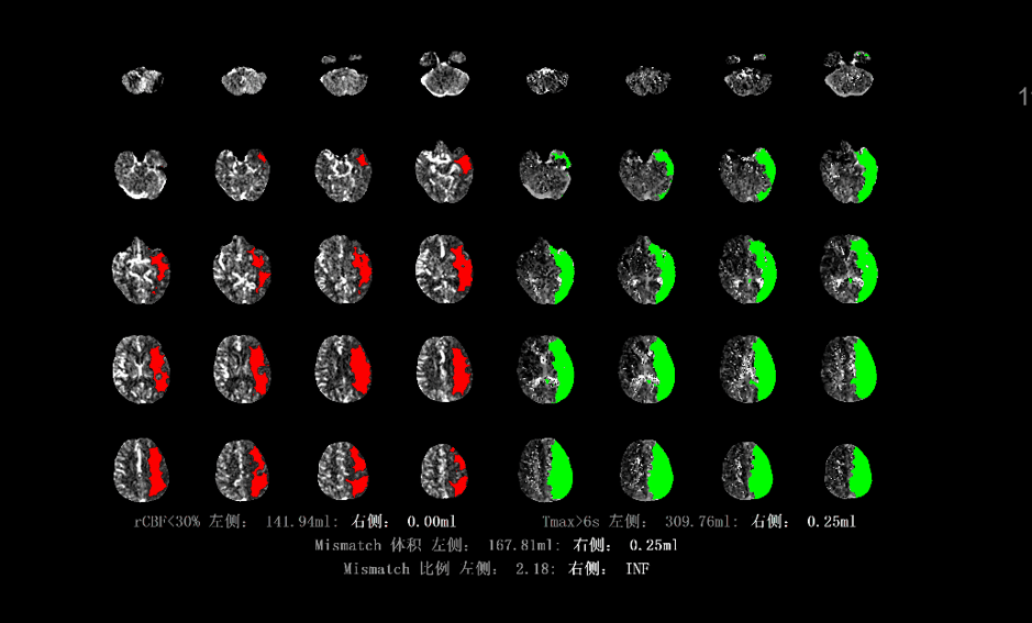 国械注准什么意思东软医疗再填空白！国内首个“持证上岗”的AI脑缺血诊断软件诞生！_https://www.jmylbn.com_新闻资讯_第3张