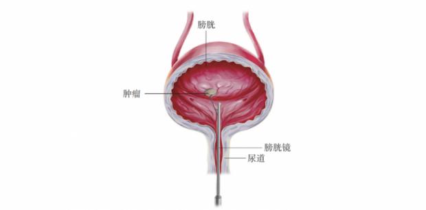 膀胱镜检查示意图