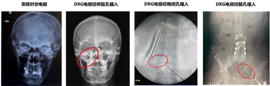　　瑞神安SCS注册临床试验