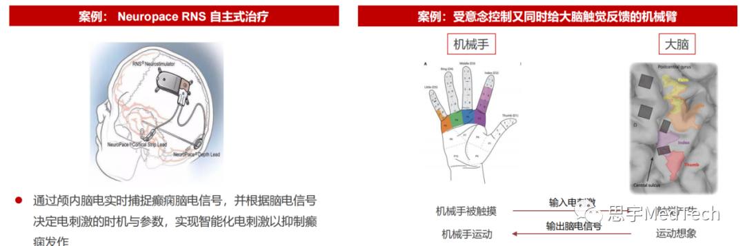 资料来源：华兴资本分析、Neuropace官网