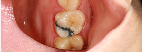 什么是显微镜手术西默牙科显微镜，牙医们的首选国产口腔显微镜品牌_https://www.jmylbn.com_新闻资讯_第12张