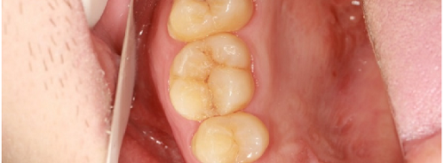 什么是显微镜手术西默牙科显微镜，牙医们的首选国产口腔显微镜品牌_https://www.jmylbn.com_新闻资讯_第11张