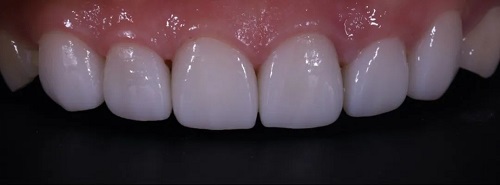 什么是显微镜手术西默牙科显微镜，牙医们的首选国产口腔显微镜品牌_https://www.jmylbn.com_新闻资讯_第16张