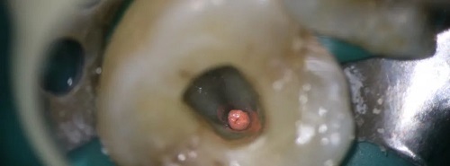 什么是显微镜手术西默牙科显微镜，牙医们的首选国产口腔显微镜品牌_https://www.jmylbn.com_新闻资讯_第14张