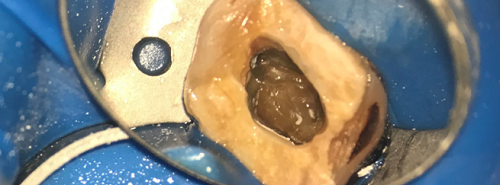 什么是显微镜手术西默牙科显微镜，牙医们的首选国产口腔显微镜品牌_https://www.jmylbn.com_新闻资讯_第13张