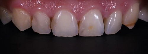 什么是显微镜手术西默牙科显微镜，牙医们的首选国产口腔显微镜品牌_https://www.jmylbn.com_新闻资讯_第15张