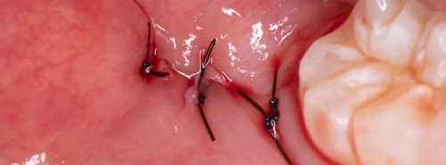 什么是显微镜手术西默牙科显微镜，牙医们的首选国产口腔显微镜品牌_https://www.jmylbn.com_新闻资讯_第18张