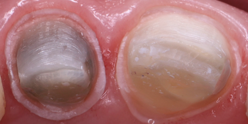 什么是显微镜手术西默牙科显微镜，牙医们的首选国产口腔显微镜品牌_https://www.jmylbn.com_新闻资讯_第19张