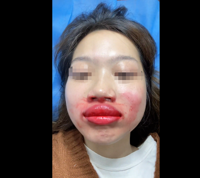 唇色矫正到一半,嘴唇肿了起来.图|视频截图