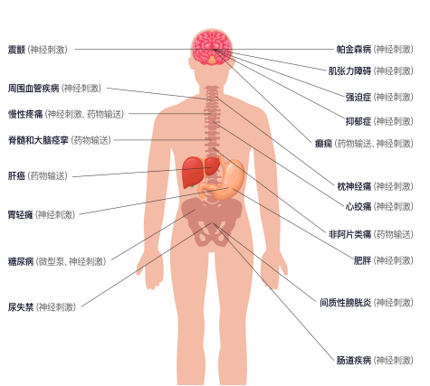 　　图3 神经调控应用
