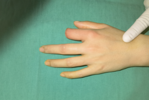 手指再造医院全国排名|佛山手指离断可以再造吗_多年断指再造费用