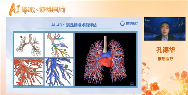 　　AI-4D可满足胸外科等临床科室精准术前评估的需求