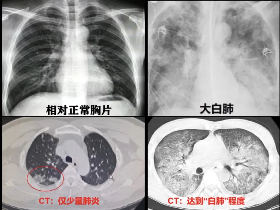 ct影像出现"白色"就是"白肺"?重型肺炎预警信号有哪些?