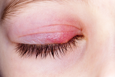 是眼科非常常见的疾病,它最典型的表现就是在睫毛根部长出红色的肿块