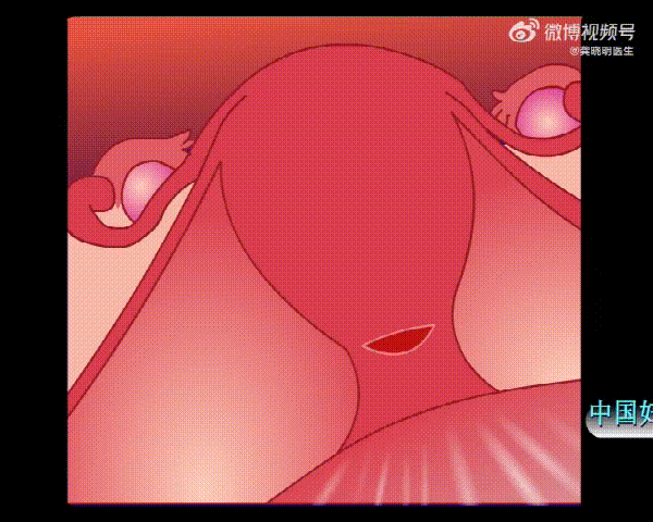 背包缝合术（B-Lynch缝合术）示意图，图源：见水印