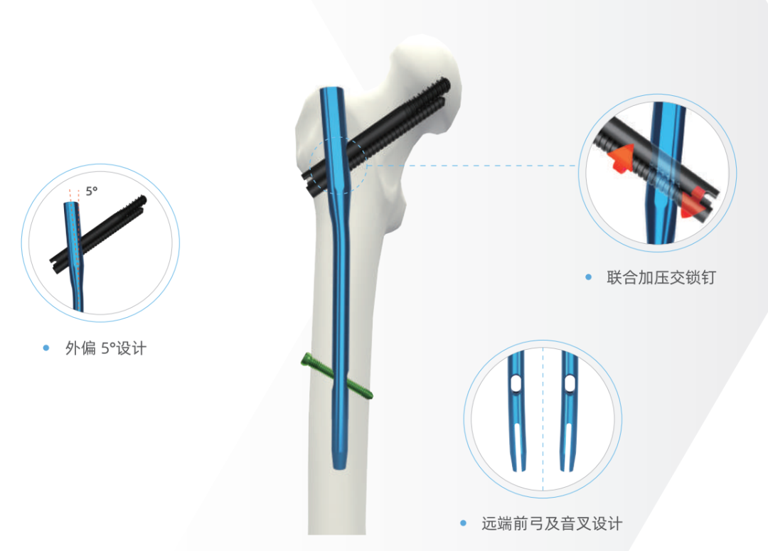 髋部联合加压交锁髓内钉与股骨近端防旋髓内钉治疗
