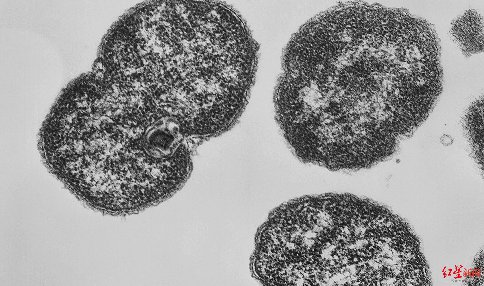 美国首次检测出新超级淋病菌株对抗生素耐药性更强专家表示仍在持续