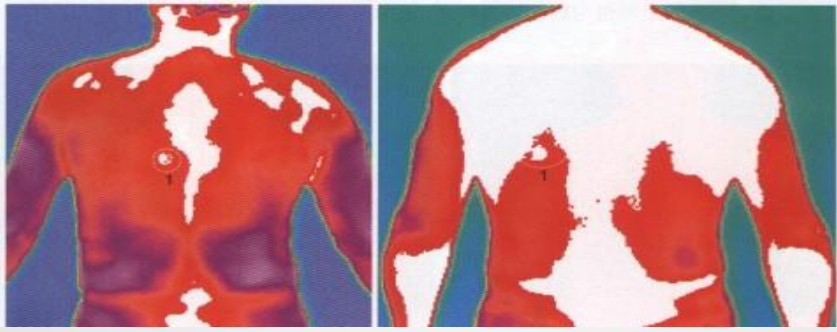 △胃穴背面图：胃体体表投影区，提示胃的较严重病变可能。