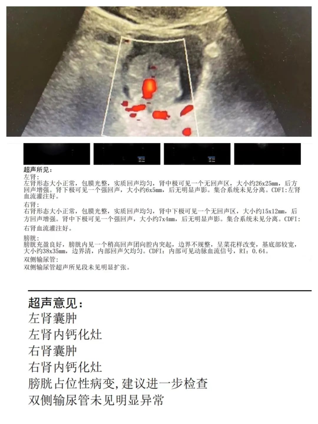 报告传给了王先生,并告知病变的危险性:"建议您及时到三甲医院专科