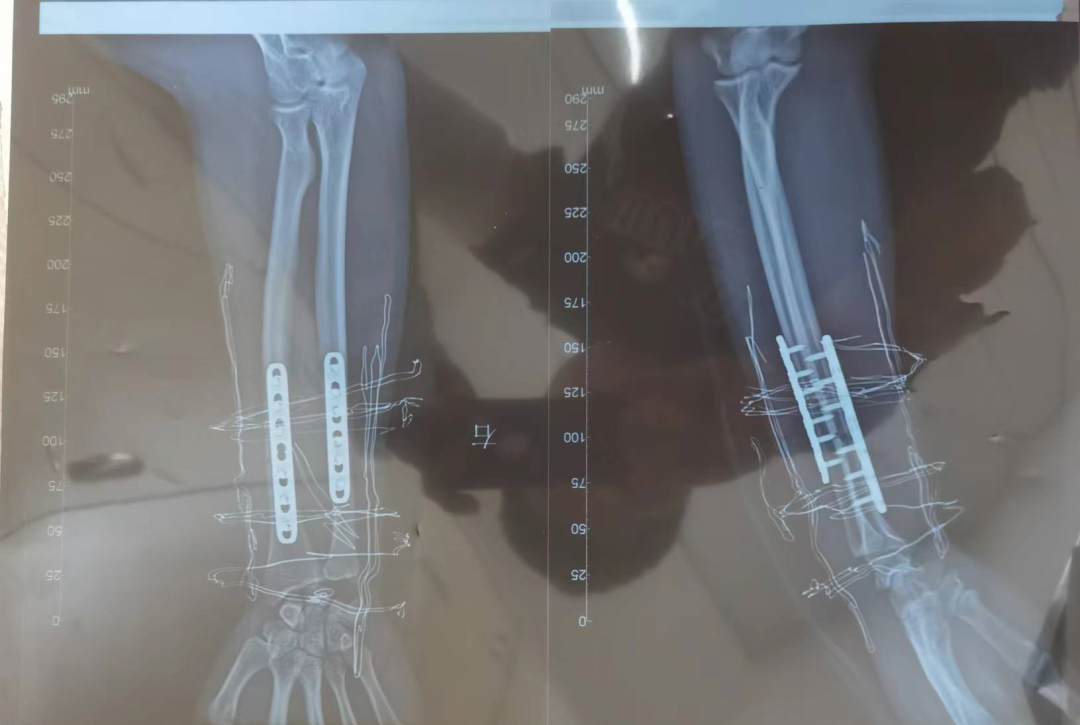 唐超右手臂上一共打了12个钢钉