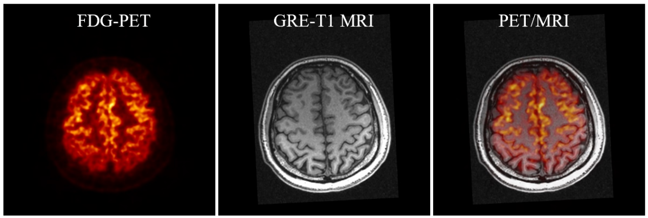 SIAT bPET和联影uMR790 3T磁共振成像系统上同时获得的人脑PET/MRI图像 来源：深圳先进院供图