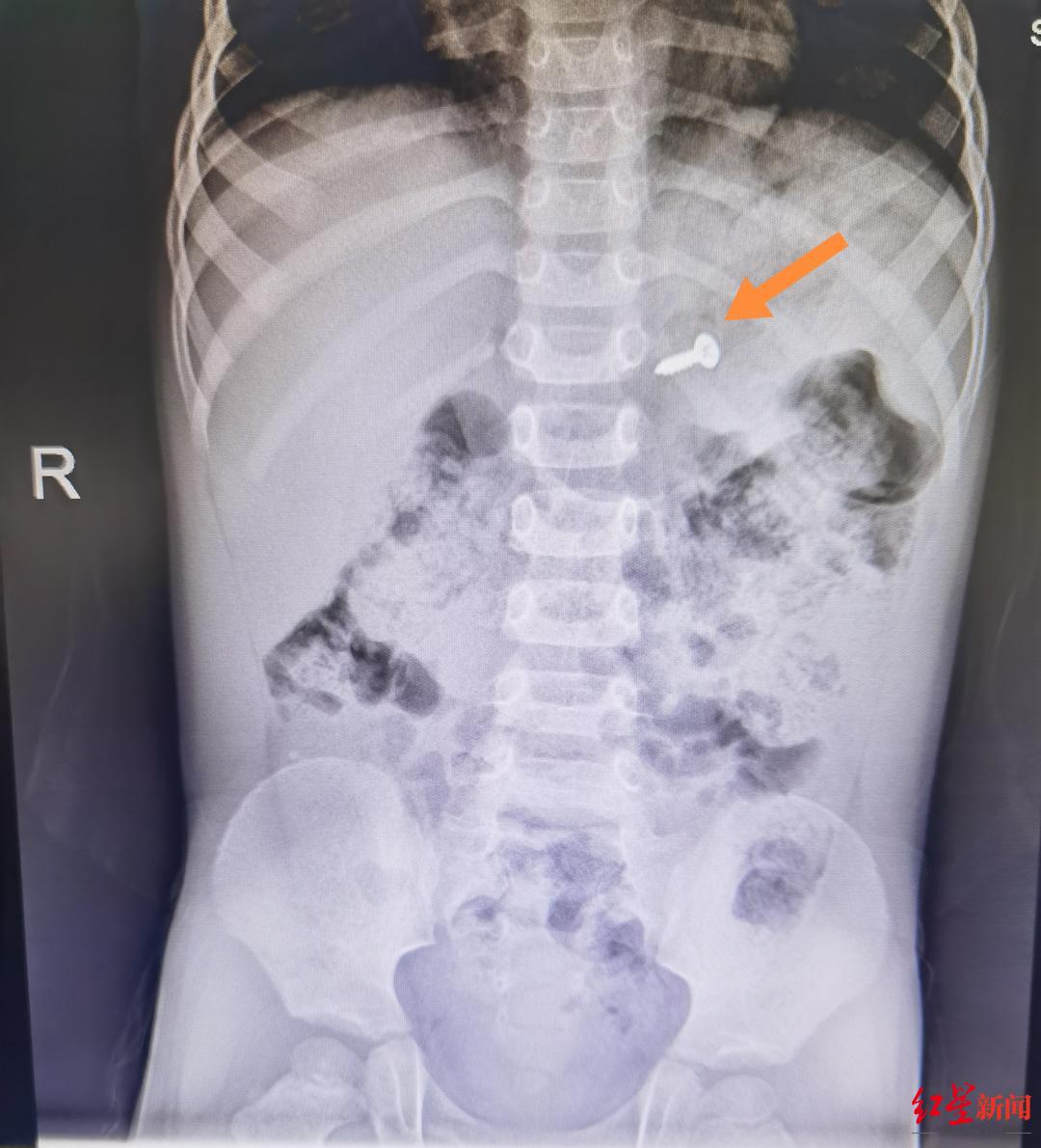 ▲2月1日，螺丝钉在患儿胃部