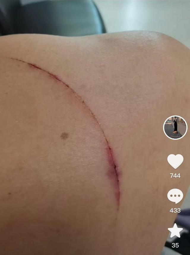 方先生被割的伤口.图/视频截图