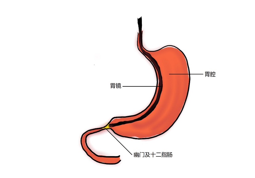 图6 胃及胃镜示意图