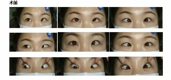 改良nishida术式四两拨千斤助力31岁斜视患者改"斜"归正|手术|弱视